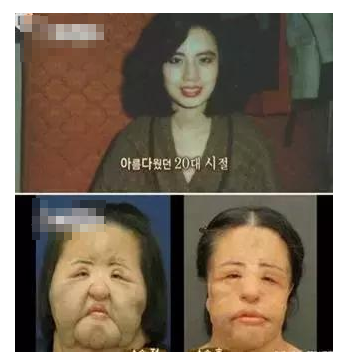整容發(fā)生意外保險賠嗎？